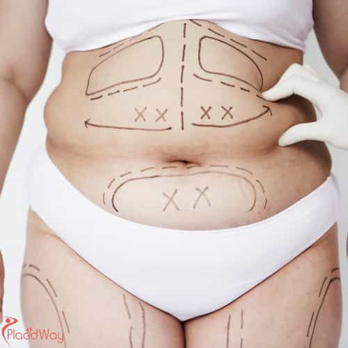 Liposuction Trends in Thailand: From Full-Body to VASER Techniques